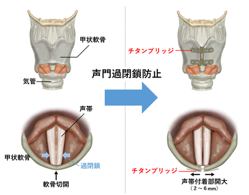 声帯 痰 が 絡む